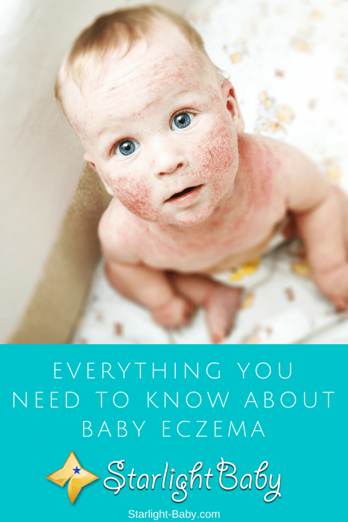 Everything You Need To Know About Baby Eczema