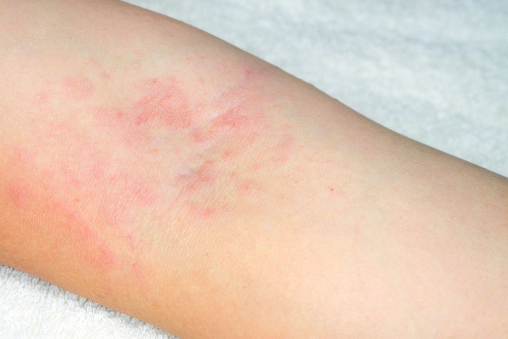 allergy to red rash on the arms on white background