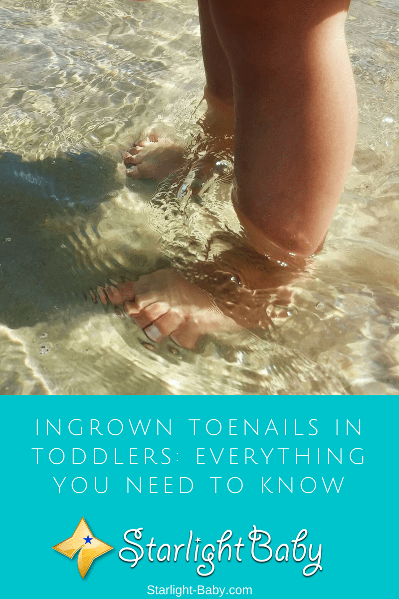 Ingrown Toenails In Toddlers: Everything You Need To Know